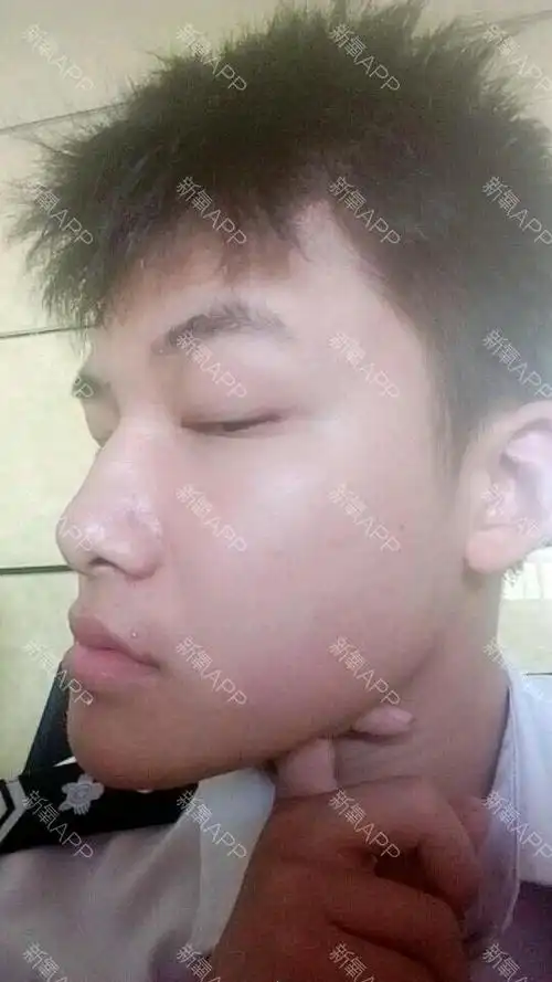 我的下巴突出来地包天 但是牙齿没有问题