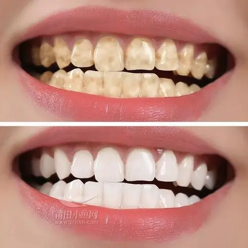 牙齿美白有哪些误区? 大家一定要避免走入误区!