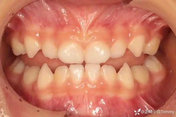 丁香园论坛>口腔>帖子详情>引导患者让下颌前伸,前牙咬到切对切,后牙