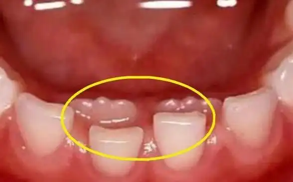 原创宝宝长出双排牙,罪魁祸首原来是妈妈给宝宝做食物的习惯出问题