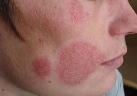 脸上长癣的图片和症状