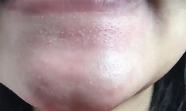 封闭皮肤代谢通道,不断凸起长成的小颗粒