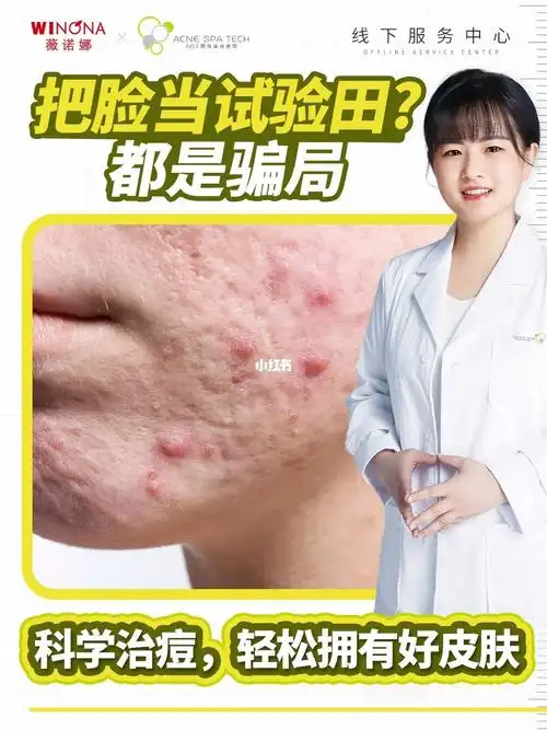 痘敏肌必看科学战痘轻松拥有好皮肤