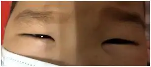 孩子眼睛肿?可能不光是没睡好!_治疗