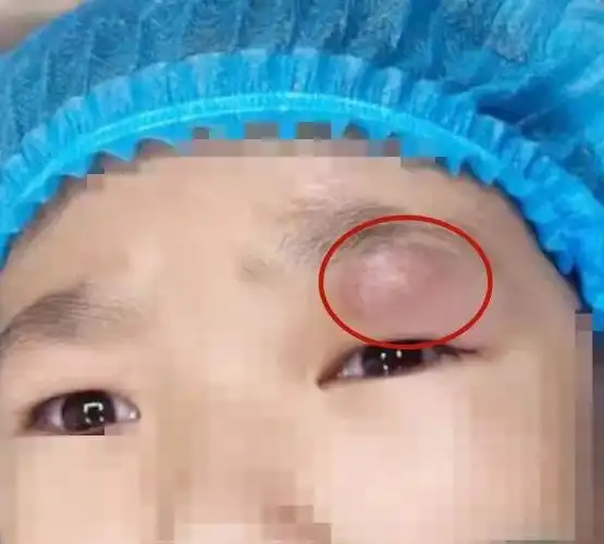 儿童眼外伤不可忽视!疯狂石头竟「深藏」在 9 岁女孩眼皮下一年之久