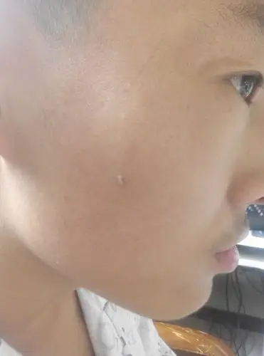 我今年16岁男脸上右边长了个和痦子差不多的东西很小但