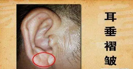 头条问答 - 山根有横纹和耳垂有纵纹代表人身什么部位出现什么病证?