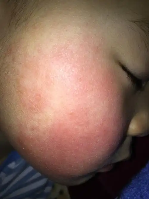 最近几天越来越严重了,两个脸都是红的了