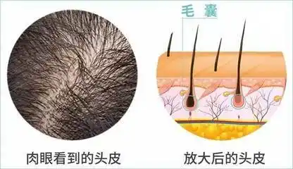 植发须知|如何解决毛囊永久闭合问题?_头发