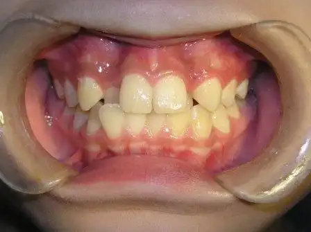 腭向错位的上侧切牙矫正过程组图原创