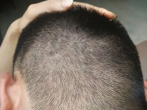 头上起的这是啥?头皮发红