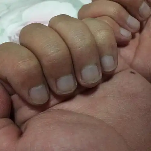 指甲没有受过伤,也没有手脚冰冷就一直处于这样的暗紫色,没有这是什