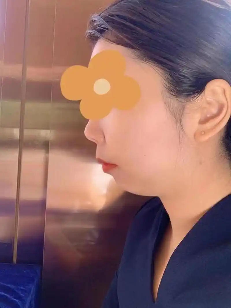 下巴后缩主要是由于生长发育问题或外观原因引起的.