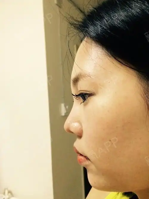 术前正侧面照片