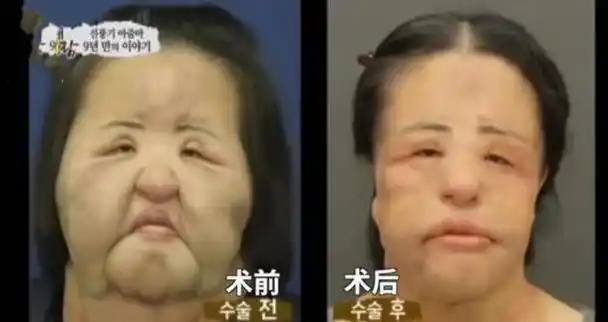整容变毁容:网红百万整成女鬼,女星头顶整出大洞,简直惨不忍睹