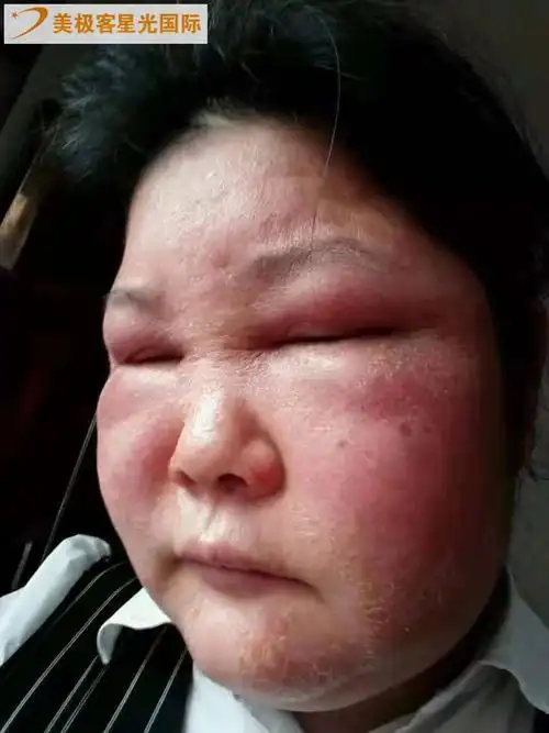 【视频】急性肾炎脸肿无尿现在她又变回美丽