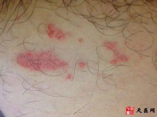 肛门,腹股沟,双大腿内侧,臀部等部位,出现下列症状时,说明已感染股癣