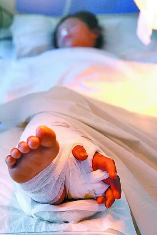 医生将断臂接到腿上再移植,最后成功了吗|截肢|小丽|左臂|左手臂_网易