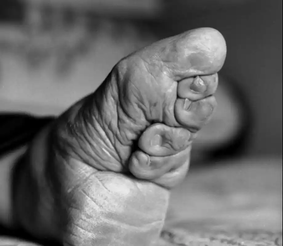 一般女性从四,五岁起便开始缠足,直到成年骨骼定型后方将布带解开