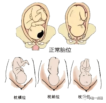 臀位却难产?_胎儿