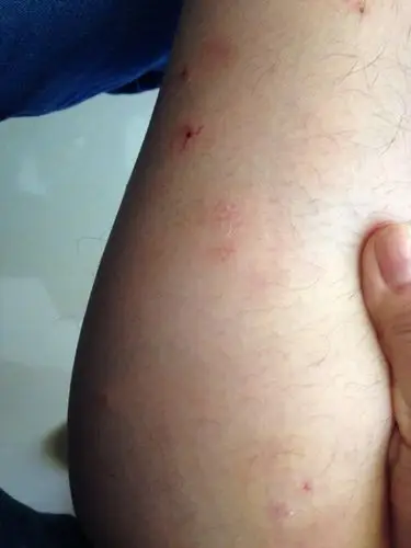 展开全部 建议你上张你小腿部位的照片,由于没有看到包的具体状况,