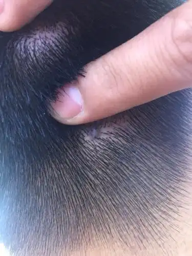 展开全部 你好,这种情况可能是毛囊囊肿导致的,一般,和炎症有关系