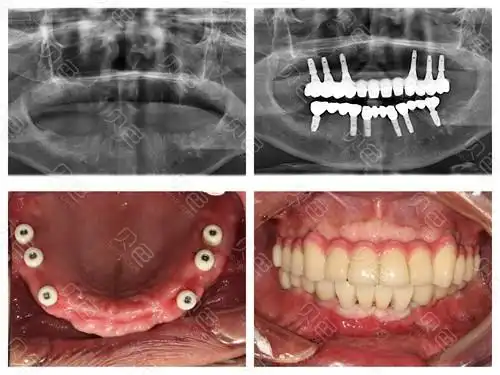 半口,全口种植牙收费价格表更新,看半口,全口收费贵不