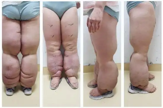 "大象腿妈妈"拯救战:唐举玉教授团队成功开展改良charles手术治疗下肢