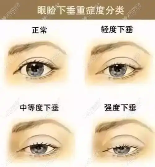 眼睑下垂的分类