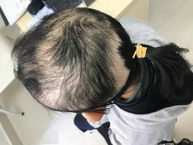 "拔毛症"女孩又留起了秀发,心理"云"护理让她重新拥抱生活_阿姨_欧婉