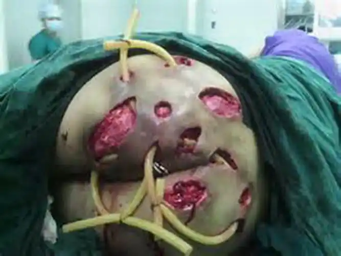 一期梅毒图片——肛门部硬下疳图片_有来医生