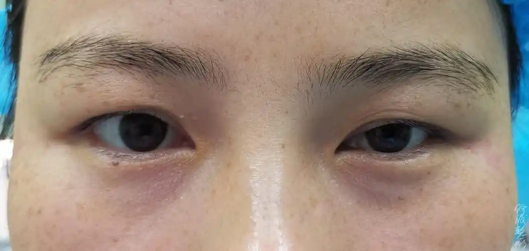 还有睁眼发现两只不对称(大小眼)也可能是一只眼存在上睑下垂