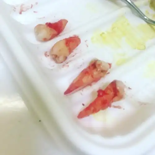 告别小虎牙隐适美矫正日记