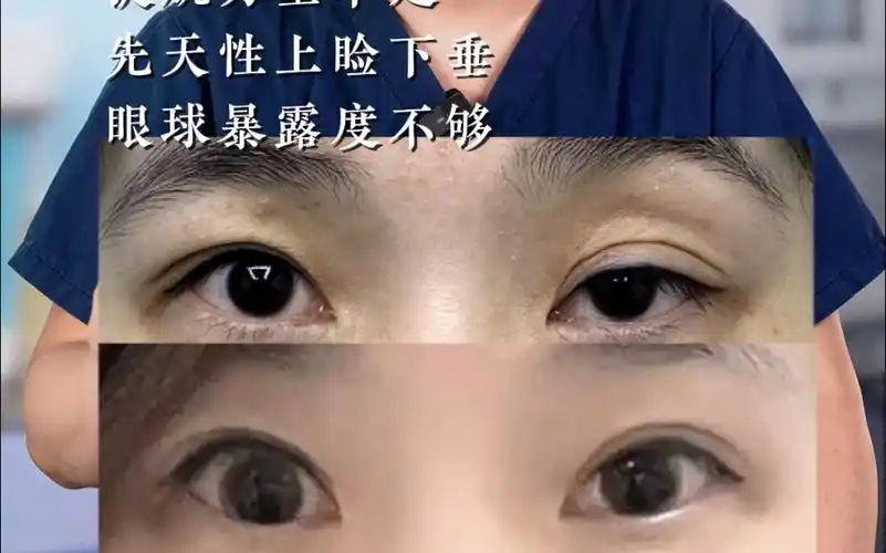 双眼皮修复,改善上睑凹陷,提肌无力.