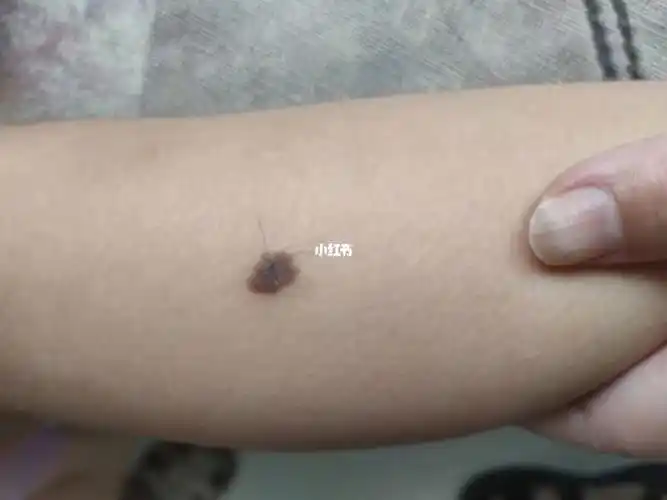 孩子腿上的是痣吗