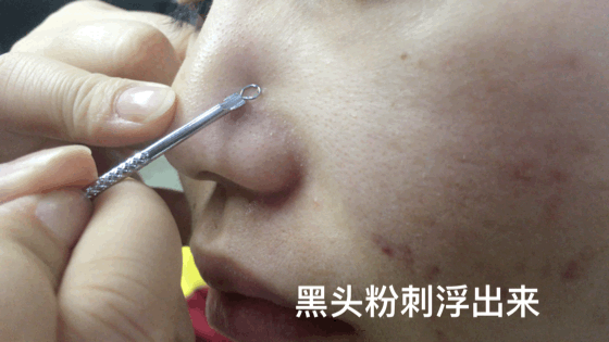 一口气挤出所有陈年黑头实在是太太太太爽了