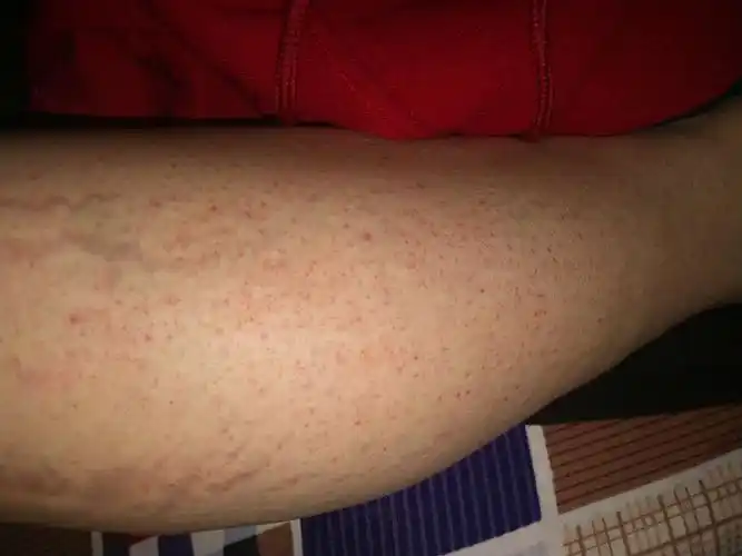 腿上有红色斑点怎么回事-系统性红斑狼疮康复圈-觅健