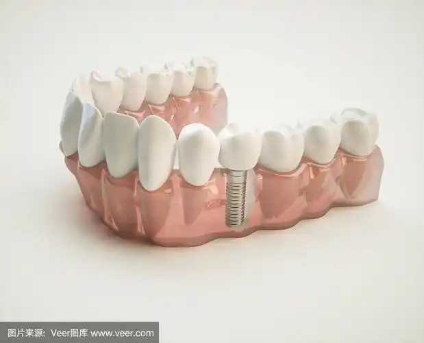 牙科种植- 3d渲染