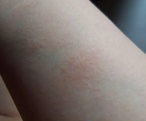 洗澡出汗后身上起红团,发痒.