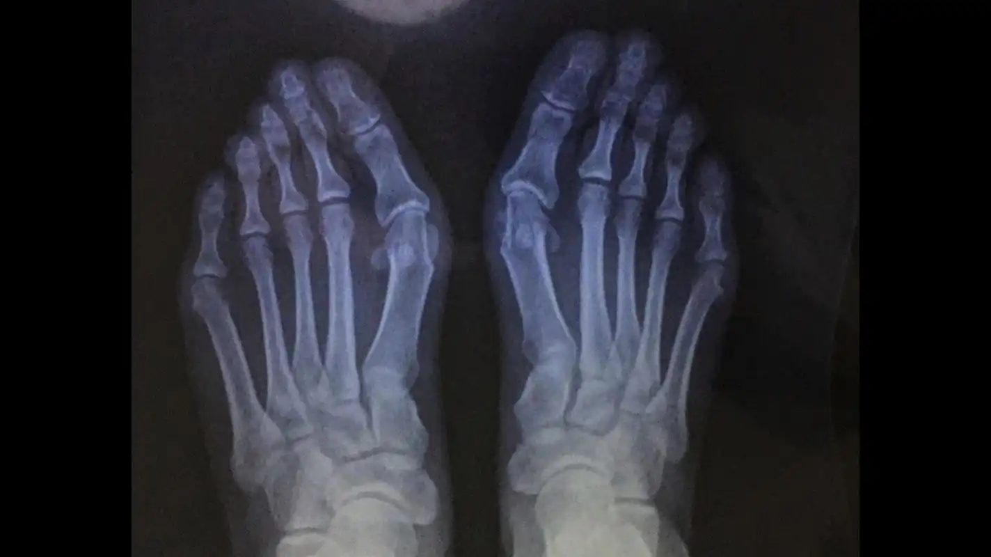 x光片更直观了解大脚骨 如果单纯去掉凸起能否有效矫正拇外翻呢?