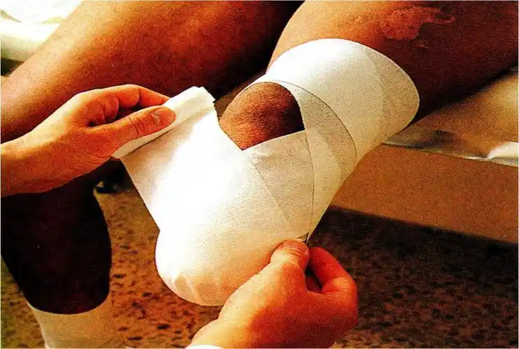 截肢者弹性绷带使用的重要性及方法