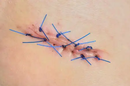 女人的腿上的皮肤活检后缝合的伤口照片