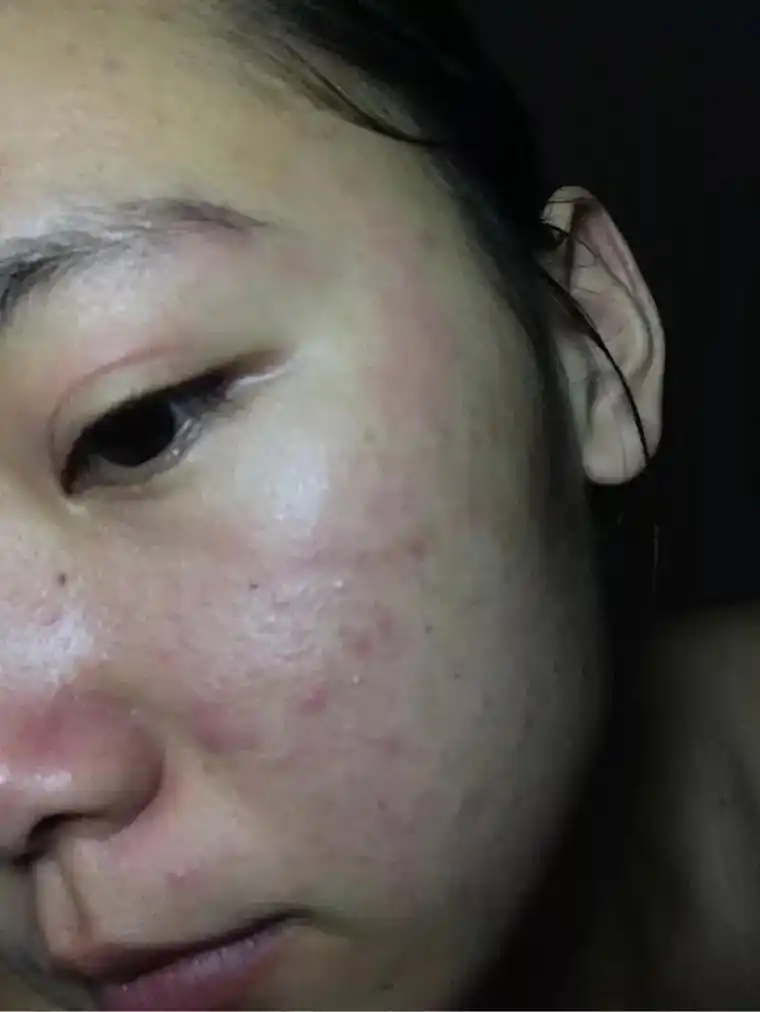 修复红血丝角质层薄 #彻底摆脱 - 抖音