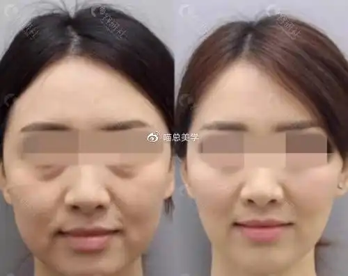 面部提升效果前后对比照