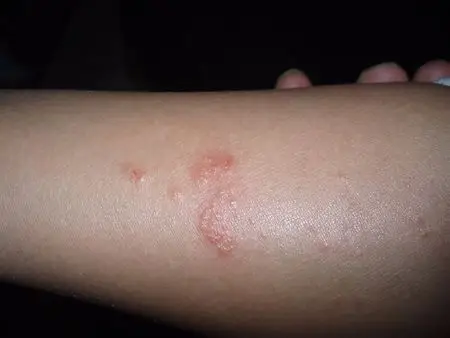 医疗健康 皮肤科满意回答  2013-02-02 21:50 过敏性皮炎.