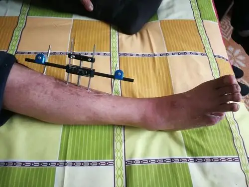 新技术 | 孝义市人民医院骨科开展胫骨横向骨搬移术让患者避免了截肢