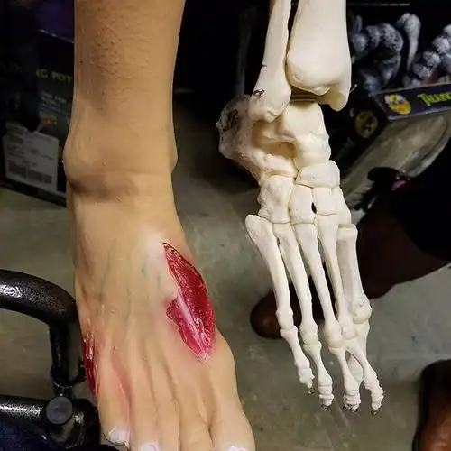 因癌症被截肢后 她和截掉的断脚成了自拍小伙伴