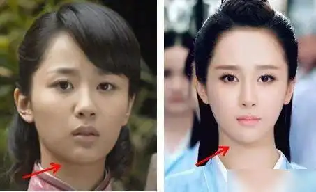 杨紫竟成整形医院案例脸型对比图再引热议眼睛还被胶布遮盖