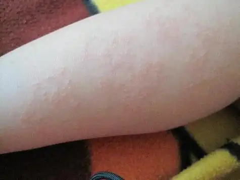 婴儿花斑:宝宝皮肤上的常见现象及其原因解析