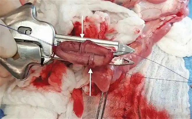 胃肠吻合术使用线型吻合器的六大步骤 - 折断线用什么线型 - 实验室